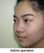 plastic_surgery_augmentation_rhinoplasty